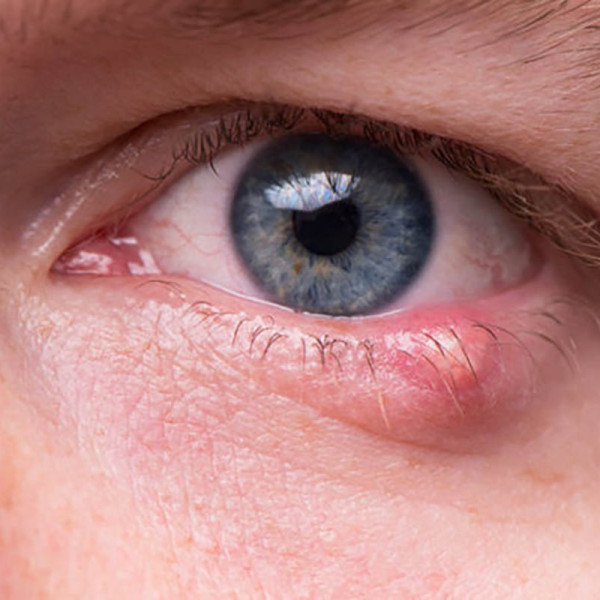 سری مطالب جذاب و کاربردی: انواع گل مژه و راه‌های درمان آن