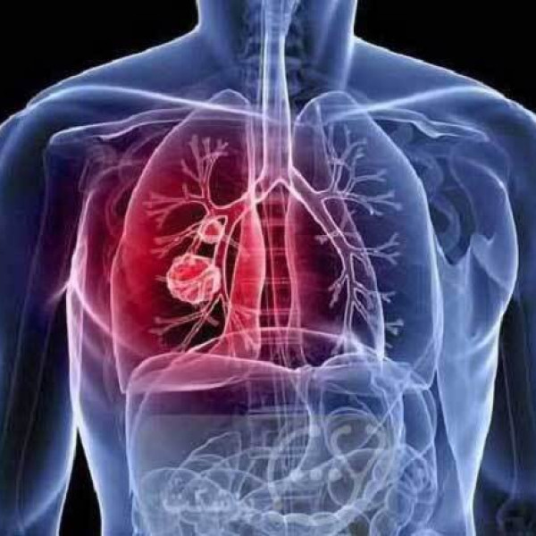 هشدار! صدای گرفتگی و سرفه ممکن است نشانه یک سرطان زنانه باشد، این موضوع را جدی بگیرید