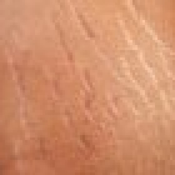 ترک‌های پوستی؛ علل و راه‌های درمان آن