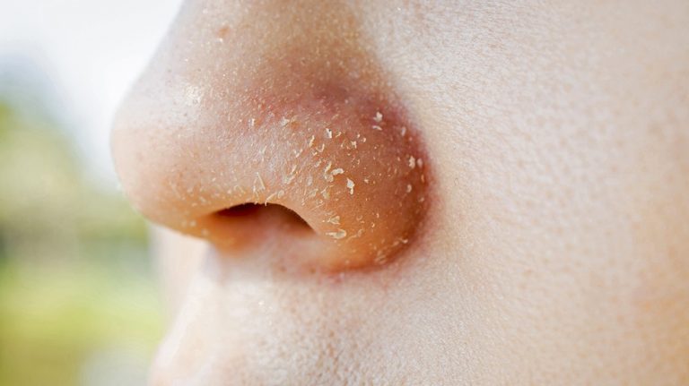 دلیل پوسته پوسته شدن روی بینی چیست؟