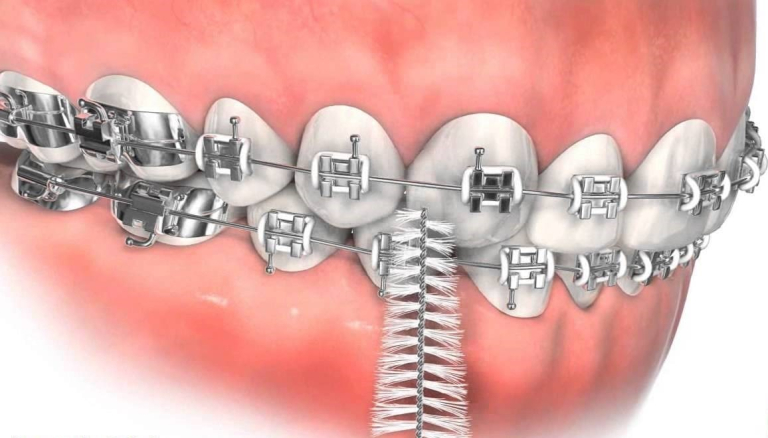 رعایت بهداشت دهانی در طول درمان ارتودنسی