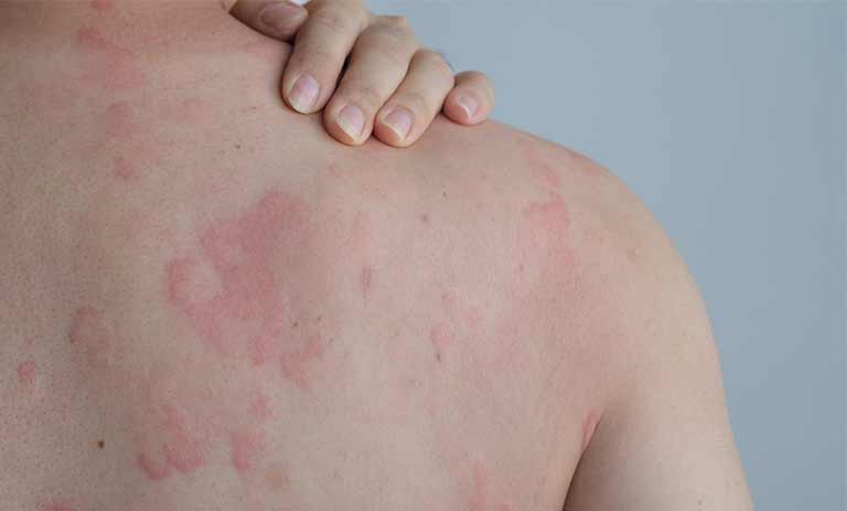 راه‌های شناخت و درمان آلرژی پوستی: علائم، تشخیص و روش‌های موثر درمان