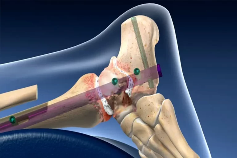 رازهای جراحی فیوژن مچ پا: از نحوه انجام تا عوارض آرترودز