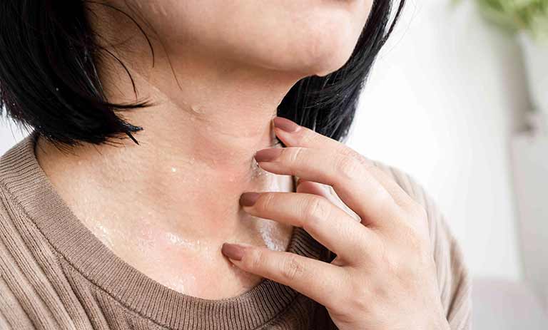 راه‌های آسان و کارآمد برای درمان عرق سوز در خانه