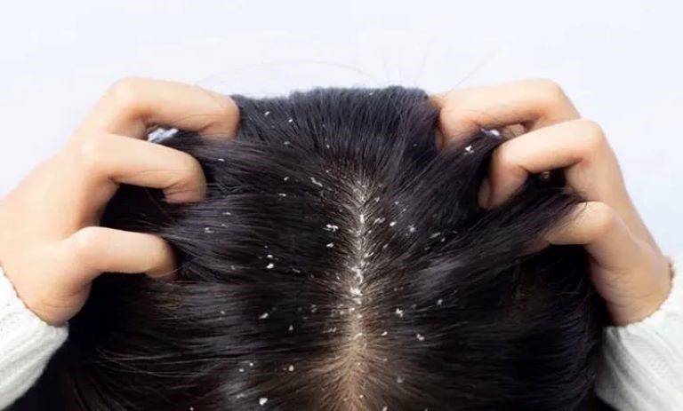 کمبود چه ویتامینی باعث شوره سر می‌شود؟