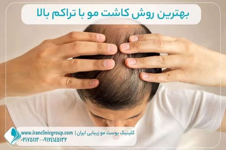 راز کاشت مو با تراکم بالا: همه چیزی که باید بدانید برای بهترین نتایج