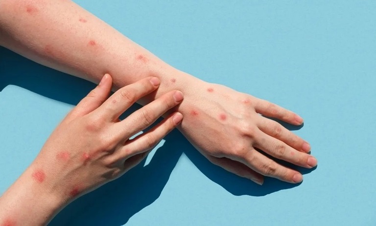 آبله میمون: رازهای پشت پرده این بیماری ترسناک