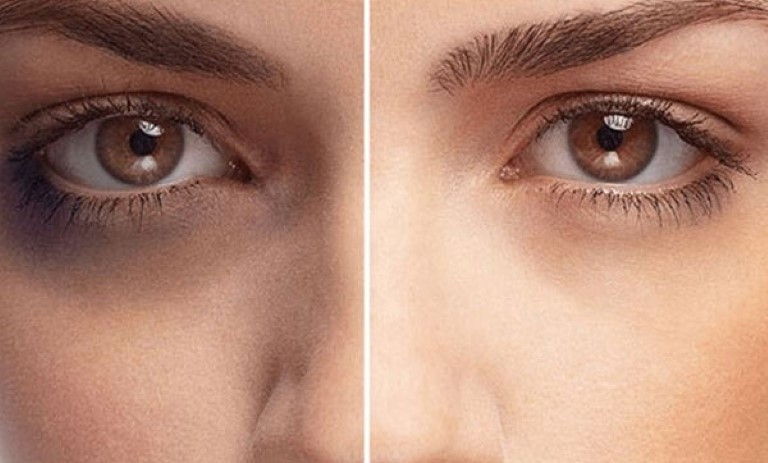 چشمان شما احتیاج به چه ویتامین‌هایی دارند؟ به دنبال راه حل برای سیاهی دور چشم‌ها هستید؟