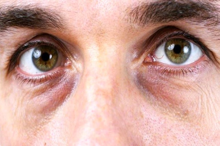 چشمان تاریکی: نشانه مرموز برای بیماری‌های مختلف