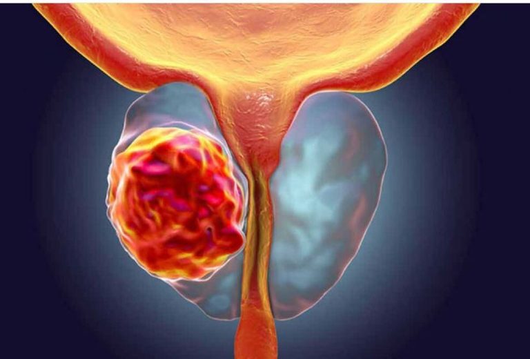 نگهداری از سلامت پروستات: راه‌های ساده برای پیشگیری و درمان