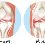 8 تا از جدیدترین روشهای درمان آرتروز زانو بدون جراحی