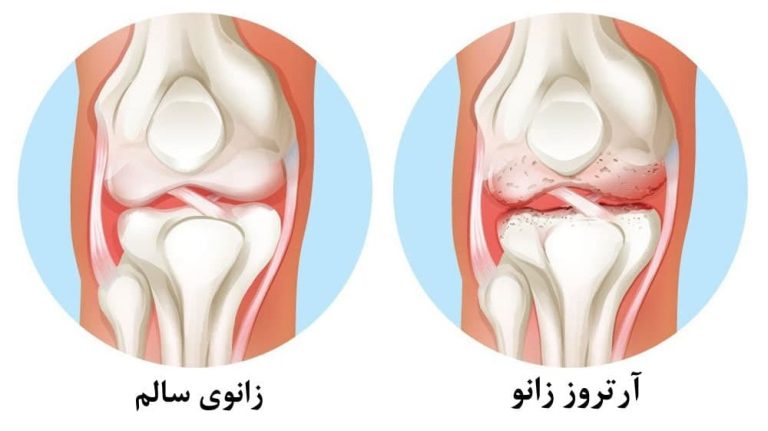 8 تا از جدیدترین روشهای درمان آرتروز زانو بدون جراحی