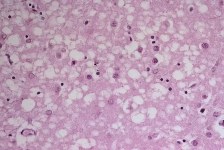 کُشنده‌ترین بیماری‌ها؛ از بی‌خوابی خانوادگی مرگ‌آور تا بیماری خنده