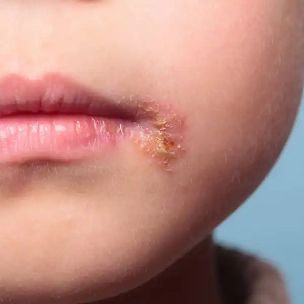 تعبیر خواب تاول روی صورت برای زن متاهل و باردار و دختر مجرد از روانشناسی