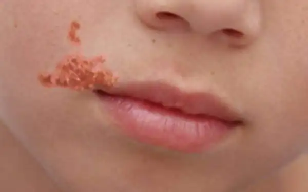 تعبیر خواب تاول زدن روی صورت برای زن متاهل و باردار و دختر مجرد از روانشناسی