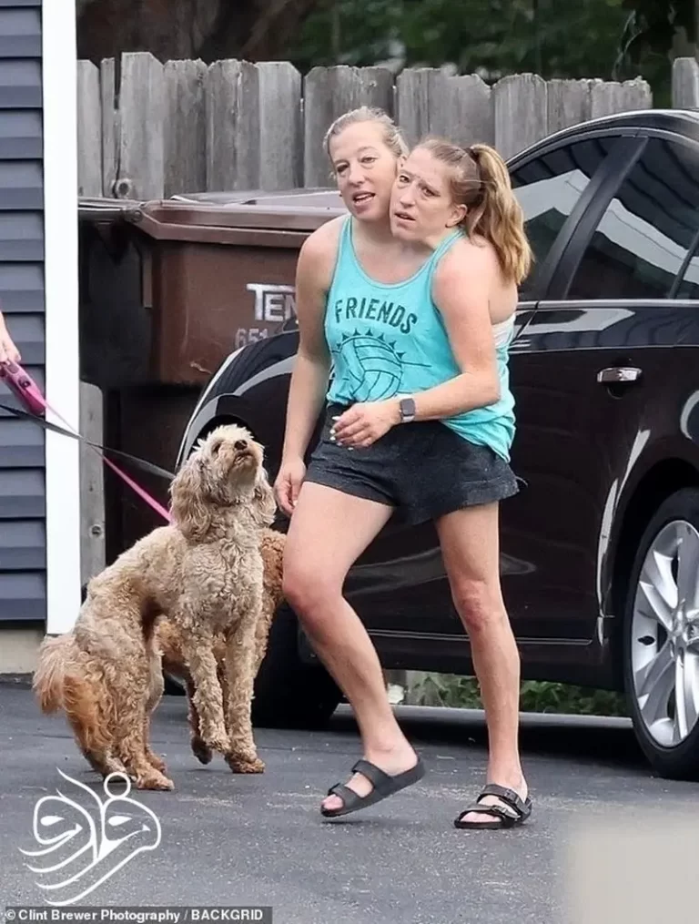 رازهای جدید دوقلوهای به‌هم‌چسبیده با تصاویر جنجالی نوزاد