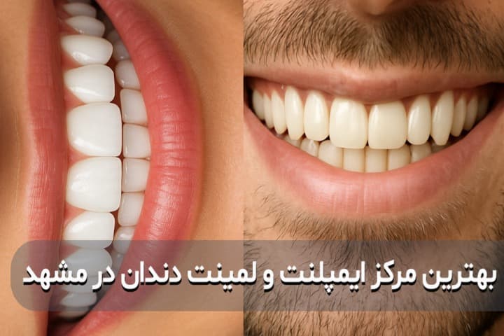 بهترین مرکز ایمپلنت و لمینت دندان در مشهد | معرفی دکتر چالاک 