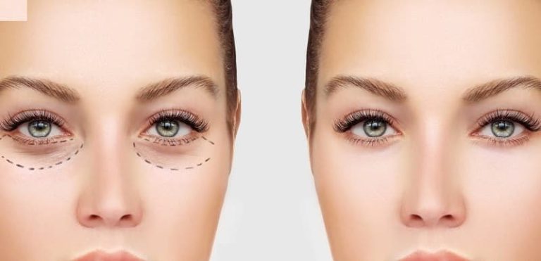 بلفاروپلاستی در بهترین کلینیک اهواز 