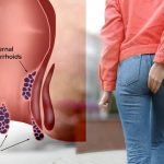 درمان قطعی بواسیر با لیزر؛ پایان دردهای همیشگی در بیماری های نشیمنگاهی