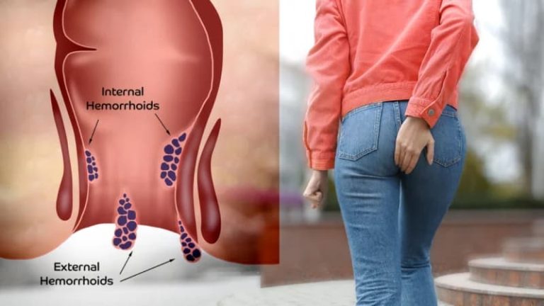 درمان قطعی بواسیر با لیزر؛  پایان دردهای همیشگی در بیماری های نشیمنگاهی