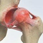 در رفتگی لگن و علائم آن – نشانه‌ها، تشخیص و درمان