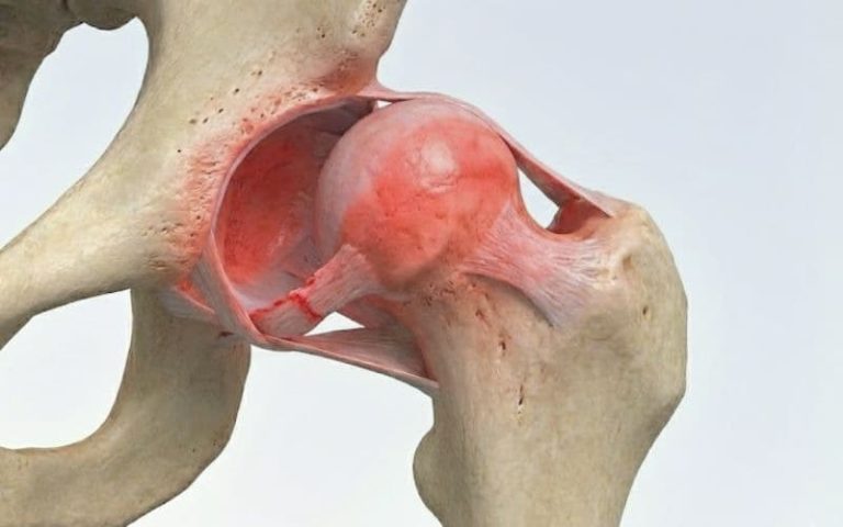 در رفتگی لگن و علائم آن – نشانه‌ها، تشخیص و درمان